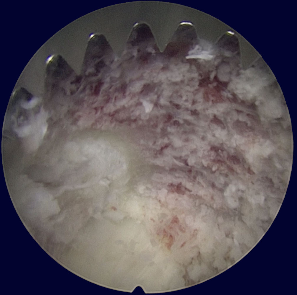 endoscopic system shot