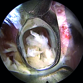 Instrument is inserted in the endoscope working channel
