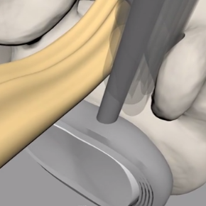 Access to disc space – after full-endoscopic facetectomy