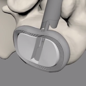 Preparing disc space with endoscopic rasp