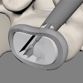 Changing working tube for usage of bigger instruments