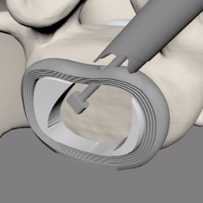 Changing working tube for usage of bigger instruments