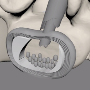 Preparing disc space with endoscopic curette 90°