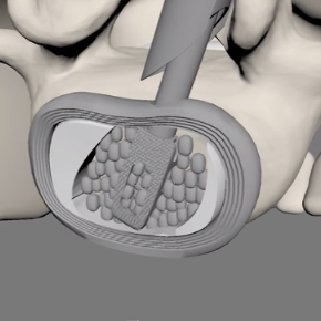 Preparing disc space  with endoscopic chisel