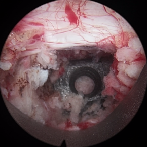 Refilling the disc space with bone fragments or artificial bone subsitute