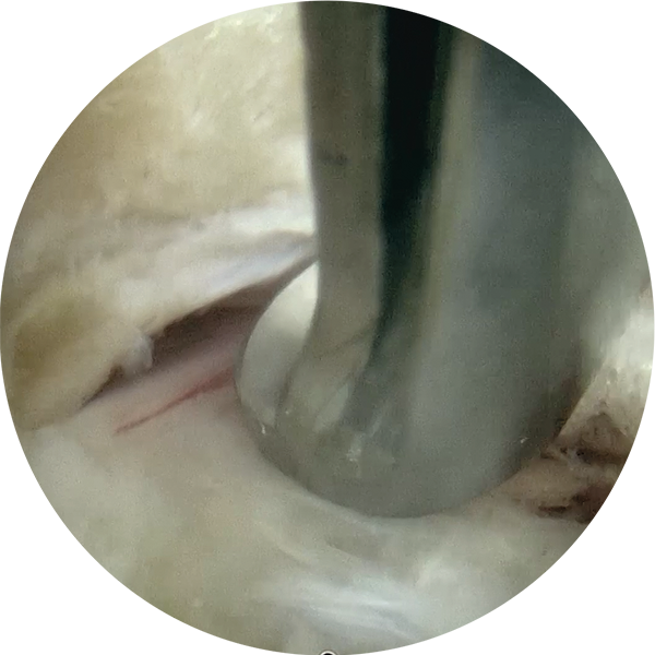 Kerisson punch cutting Lig. flavum, transforaminal access