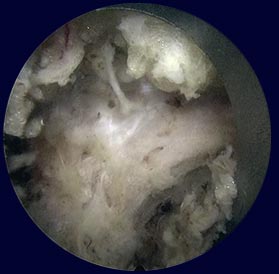 Endoscopic decompression with various instruments