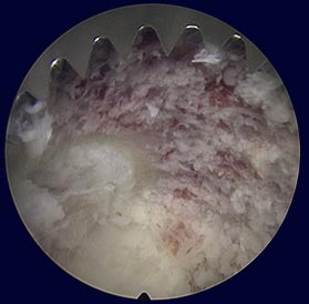 Endoscopic view to intervertebral foramen