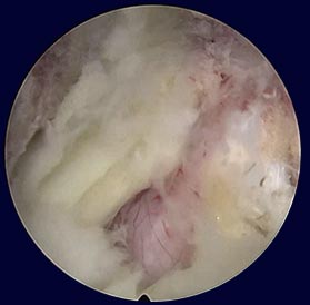 Endoscopic decompression with various instruments