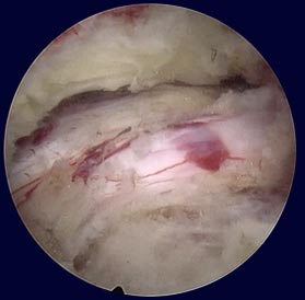 Endoscopic decompression with various instruments