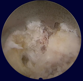 Endoscopic decompression with various instruments