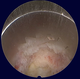 Endoscopic view to intervertebral foramen