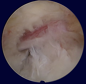 Endoscopic decompression with various instruments