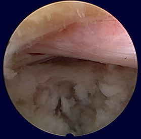 Endoscopic decompression with various instruments