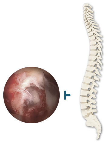 TLIF spine operation