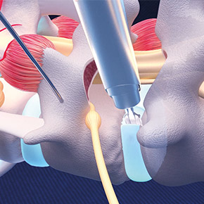 Access to disc space – after full-endoscopic facetectomy