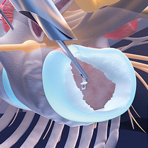 Preparing disc space  with endoscopic chisel