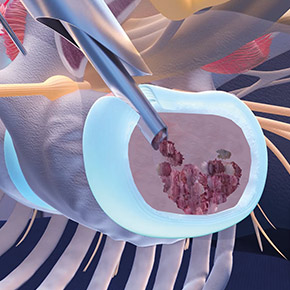 Refilling the disc space with bone fragments or artificial bone subsitute