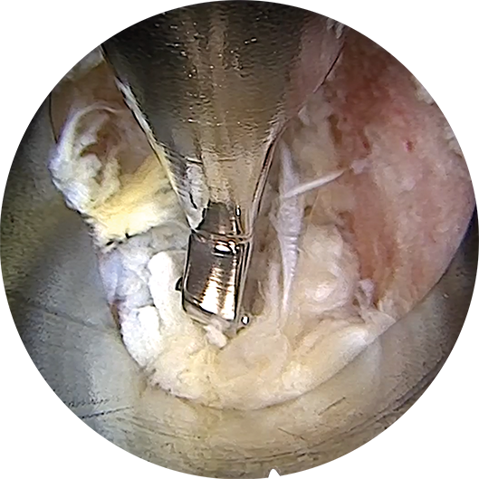 Instrument is inserted in the endoscope working channel